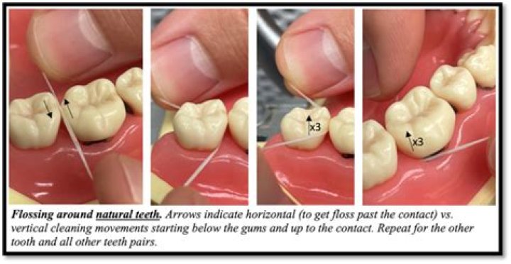 Effective Techniques For Removing A Ring With Floss