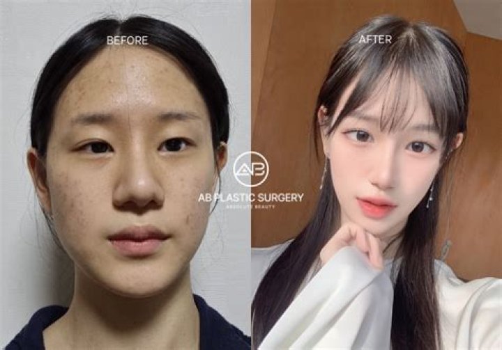 Korean Actor Plastic Surgery: Unveiling The Transformation