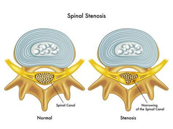 Spinal Stenosis